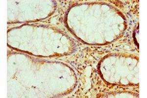 Immunohistochemistry of paraffin-embedded human colon cancer using ABIN7161681 at dilution of 1:100