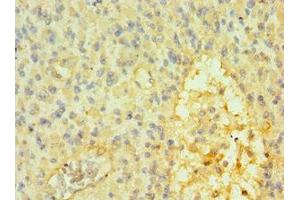 Immunohistochemistry of paraffin-embedded human glioma using ABIN7172610 at dilution of 1:100 (SOX14 Antikörper  (AA 91-240))