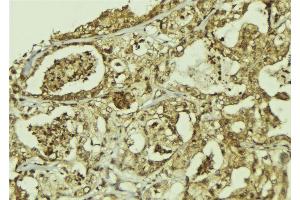 ABIN6273301 at 1/100 staining Human breast cancer tissue by IHC-P. (PPAN Antikörper  (C-Term))