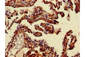 Immunohistochemistry of paraffin-embedded human lung cancer using ABIN7143899 at dilution of 1:100 (alpha-Mannosidase II Antikörper  (AA 31-181))