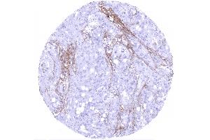 Serous high grade carcinoma of the ovary showing decorin staining of the stroma (Rekombinanter Decorin Antikörper  (AA 212-336))