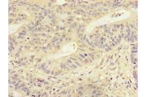Immunohistochemistry of paraffin-embedded human colon cancer using ABIN7153118 at dilution of 1:100 (Formin-Like 3 Antikörper  (AA 2-212))