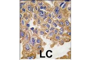 Formalin-fixed and paraffin-embedded human lung carcinoma tissue reacted with AKT2 Antibody , which was peroxidase-conjugated to the secondary antibody, followed by DAB staining. (AKT2 Antikörper  (AA 452-481))