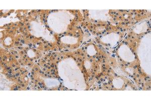 Immunohistochemistry of paraffin-embedded Human thyroid cancer tissue using ITPR1 Polyclonal Antibody at dilution 1:40 (ITPR1 Antikörper)