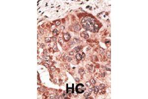 Formalin-fixed and paraffin-embedded human hepatocellular carcinoma tissue reacted with RCVRN polyclonal antibody  , which was peroxidase-conjugated to the secondary antibody, followed by DAB staining. (Recoverin Antikörper  (C-Term))