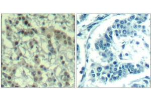 Immunohistochemical analysis of paraffin-embedded human breast carcinoma tissue using Aurora A(Phospho-Thr288) Antibody(left) or the same antibody preincubated with blocking peptide(right). (Aurora A Antikörper  (pThr288))