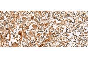 Immunohistochemistry of paraffin-embedded Human liver cancer tissue using GCC2 Polyclonal Antibody at dilution of 1:45(x200) (GCC2 Antikörper)