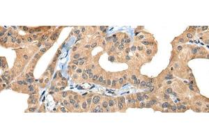 Immunohistochemistry of paraffin-embedded Human thyroid cancer tissue using BHMT2 Polyclonal Antibody at dilution of 1:30(x200)