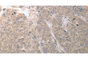 Immunohistochemistry of paraffin-embedded Human liver cancer using SLC1A4 Polyclonal Antibody at dilution of 1:70 (SLC1A4 Antikörper)