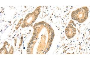 Immunohistochemistry of paraffin-embedded Human colon cancer using TSPAN13 Polyclonal Antibody at dilution of 1:35 (TSPAN13 Antikörper)