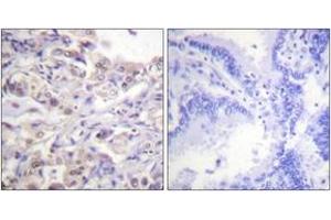 Immunohistochemistry analysis of paraffin-embedded human lung carcinoma, using hnRPD (Phospho-Ser83) Antibody. (HNRNPD/AUF1 Antikörper  (pSer83))