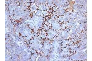 Formalin-fixed, paraffin-embedded human Ovarian Carcinoma stained with MUC16 Mouse Monoclonal Antibody (5E11). (MUC16 Antikörper)