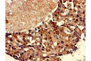 Immunohistochemistry of paraffin-embedded human breast cancer using ABIN7171581 at dilution of 1:100 (TBP Antikörper  (AA 1-55))
