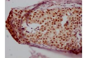 IHC image of ABIN7127589 diluted at 1:100 and staining in paraffin-embedded human breast cancer performed on a Leica BondTM system. (Rekombinanter JunB Antikörper)