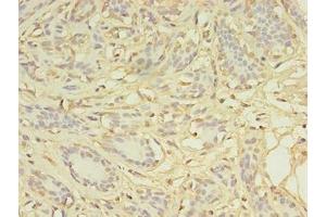 Immunohistochemistry of paraffin-embedded human breast cancer using ABIN7149384 at dilution of 1:100 (AGBL2 Antikörper  (AA 10-270))