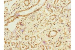 Immunohistochemistry of paraffin-embedded human pancreatic cancer using ABIN7167094 at dilution of 1:100 (RanBP3 Antikörper  (AA 1-250))