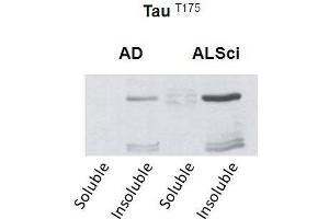 Western blot detection of insoluble phospho-Tau protein using the anti-Tau (Thr-175) antibody in samples isolated from patients with a neurodegenerative disease (Amyotropic lateral sclerosis, ALS or Alzheimer’s disease, AD (tau Antikörper  (pThr175))