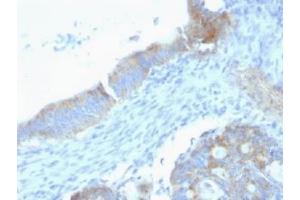 Formalin-fixed, paraffin-embedded human testicular carcinoma stained with anti-Perlecan antibody (SPM255). (HSPG2 Antikörper)