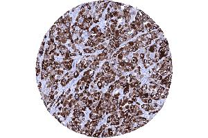 Strong cytoplasmic PMEL immunostaining in all cells of a malignant melanoma of the skin (Rekombinanter Melanoma gp100 Antikörper)