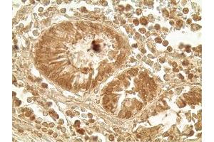 Immunohistochemistry analysis of human colon tumor tissue using Glucagon like peptide 1 pAb,  at a dilution of 1:500. (GLP-1 Antikörper  (AA 1-19))