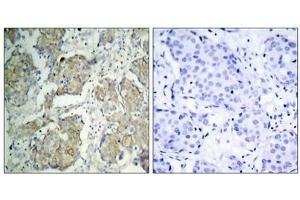 Immunohistochemical analysis of paraffin-embedded human breast carcinoma tissue using VEGFR2(Phospho-Tyr1214) Antibody(left) or the same antibody preincubated with blocking peptide(right). (VEGFR2/CD309 Antikörper  (pTyr1214))