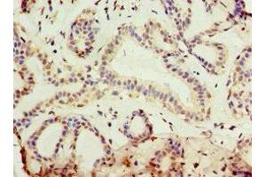 Immunohistochemistry of paraffin-embedded human breast cancer using ABIN7157726 at dilution of 1:100 (KLF3 Antikörper  (AA 1-240))