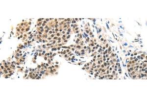 Immunohistochemistry of paraffin-embedded Human liver cancer tissue using MAGEA6 Polyclonal Antibody at dilution 1:120 (MAGEA6 Antikörper)