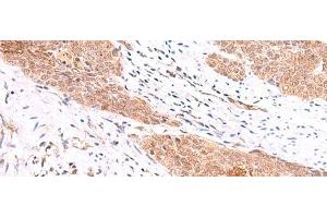 Immunohistochemistry of paraffin-embedded Human esophagus cancer tissue using COPS3 Polyclonal Antibody at dilution of 1:60(x200) (COPS3 Antikörper)