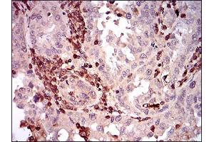 Immunohistochemical analysis of paraffin-embedded endometrial cancer tissues using CD68 mouse mAb with DAB staining.