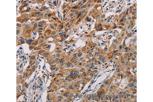 Immunohistochemistry of Human lung cancer using MMP1 Polyclonal Antibody at dilution of 1:60 (MMP1 Antikörper)