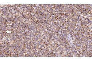 ABIN6273184 at 1/100 staining Human lymph cancer tissue by IHC-P. (SLC22A12 Antikörper)