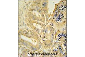 TLL1 antibody immunohistochemistry analysis in formalin fixed and paraffin embedded human prostate carcinoma followed by peroxidase conjugation of the secondary antibody and DAB staining.