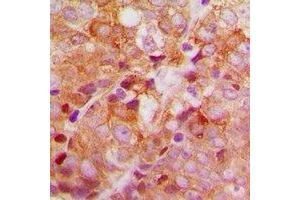 Immunohistochemical analysis of ACBD6 staining in human breast cancer formalin fixed paraffin embedded tissue section. (ACBD6 Antikörper)