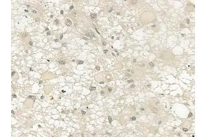 ABIN6257759 and ABIN6274371 at 1/100 staining human astrocytoma by IHC-P.