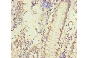 Immunohistochemistry of paraffin-embedded human colon cancer using ABIN7159632 at dilution of 1:100