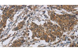 Immunohistochemistry of paraffin-embedded Human gastric cancer tissue using Claudin 8 Polyclonal Antibody at dilution 1:50 (CLDN8 Antikörper)