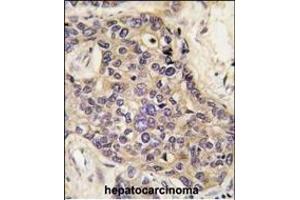 Formalin-fixed and paraffin-embedded human hepatocarcinoma tissue reacted with HGF antibody (C-term) (ABIN388462 and ABIN2848889) , which was peroxidase-conjugated to the secondary antibody, followed by DAB staining. (HGF Antikörper  (C-Term))