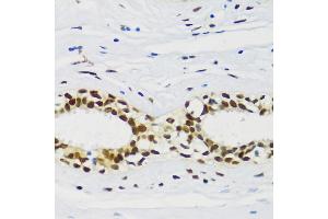 Immunohistochemistry of paraffin-embedded human breast cancer using CIRBP antibody (ABIN6129747, ABIN6138627, ABIN6138629 and ABIN6221699) at dilution of 1:100 (40x lens). (CIRBP Antikörper  (AA 1-172))