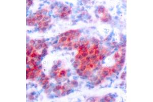 Immunohistochemistry of paraffin-embedded human breast carcinoma using Phospho-ST-Y693 antibody (ABIN3019610, ABIN3019611, ABIN3019612, ABIN1682083 and ABIN1682084). (STAT4 Antikörper  (pTyr693))