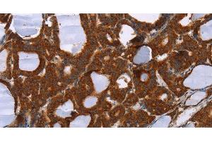 Immunohistochemistry of paraffin-embedded Human thyroid cancer tissue using PPP2R3C Polyclonal Antibody at dilution 1:30 (PPP2R3C Antikörper)