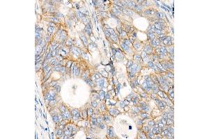 Immunohistochemistry of paraffin-embedded human colon carcinoma using MRP1/ antibody (ABIN7265736) at dilution of 1:100 (40x lens). (ABCC1 Antikörper)