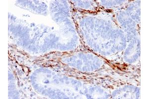 Formalin-fixed, paraffin-embedded human Colon Carcinoma stained with Nestin Mouse Monoclonal Antibody (NES/2911). (Nestin Antikörper  (AA 698-844))
