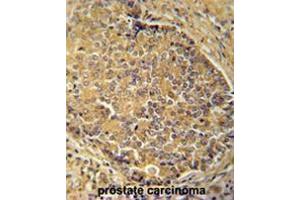 IGSF1 antibody (C-term) immunohistochemistry analysis in formalin fixed and paraffin embedded human prostate carcinoma followed by peroxidase conjugation of the secondary antibody and DAB staining.