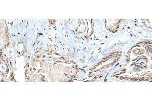 Immunohistochemistry of paraffin-embedded Human thyroid cancer tissue using SMC1A Polyclonal Antibody at dilution of 1:30(x200) (SMC1A Antikörper)
