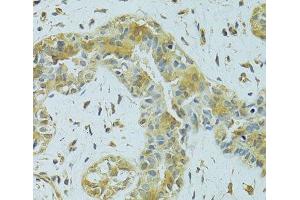 Immunohistochemistry of paraffin-embedded Human breast cancer using MTCH1 Polyclonal Antibody at dilution of 1:100 (40x lens). (MTCH1 Antikörper)