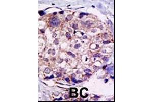 Formalin-fixed and paraffin-embedded human cancer tissue reacted with the primary antibody, which was peroxidase-conjugated to the secondary antibody, followed by DAB staining. (USP2 Antikörper  (C-Term))