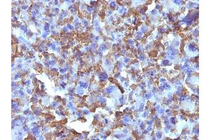 Formalin-fixed, paraffin-embedded human Histiocytoma stained with Macrophage Monoclonal Antibody (D11). (Macrophage / Histiocytoma Marker Antikörper)