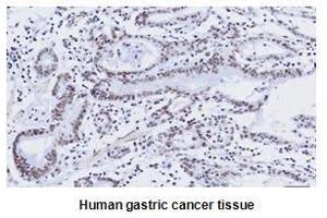 Paraffin embedded sections of human gastric canitrocelluloseer tissue were initrocelluloseubated with anti-human kLF4 (1:50) for 2 hours at room temperature. (KLF4 Antikörper  (AA 1-170))