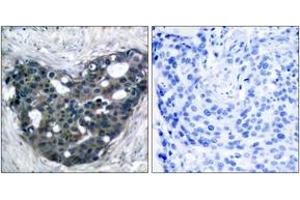 Immunohistochemistry analysis of paraffin-embedded human breast carcinoma tissue, using p56 Dok-2 (Ab-299) Antibody.