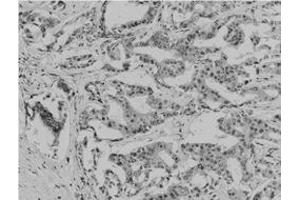 Immunohistochemical staining of paraffin-embedded human breast carcinoma tissue reacted with Acetyl lysine monoclonal antibody  at 1:200-1:500 dilution. (Acetylated Lysine Antikörper  (acetylated))